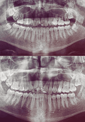 Before and after x-ray of the extraction of lower wisdom teeth on both sides