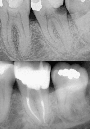 Before and after x-ray of a root canal treatment