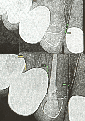 Before and after x-ray of a highly complex canine root canal treatment