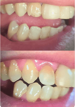 Before and after a dental restoration