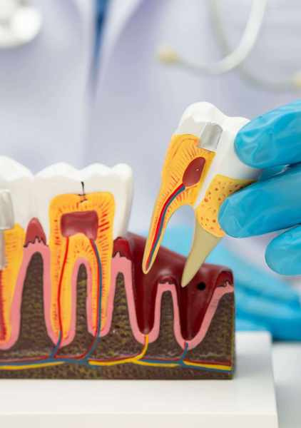 Dental implants