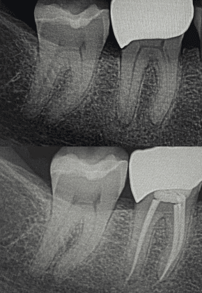 Before and after x-ray of a root canal treatment